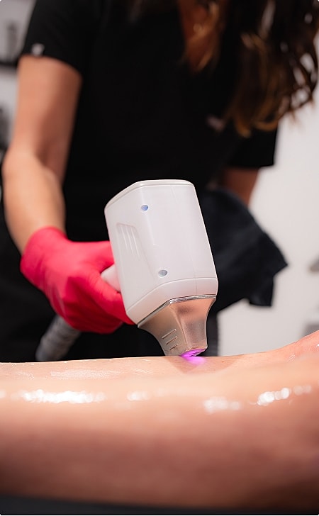 Laser treatment on a person's skin.